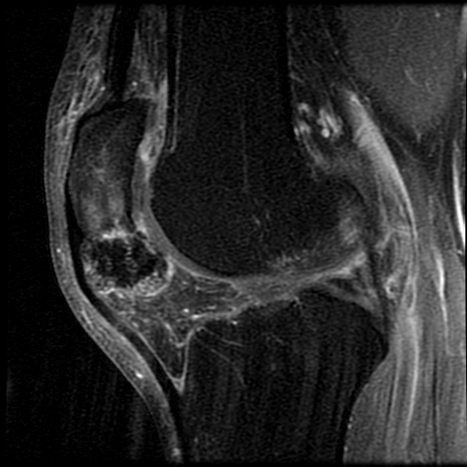 Figure 5 for case Parosteal osteoma ( RID4002 )